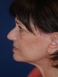 Facelift After Photo by Michael Eisemann, MD; Houston, TX - Case 28884