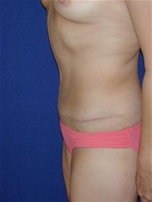 Tummy Tuck After Photo by Michael Eisemann, MD; Houston, TX - Case 28885