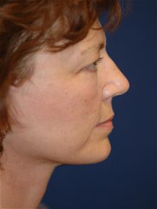 Facelift After Photo by Michael Eisemann, MD; Houston, TX - Case 28985