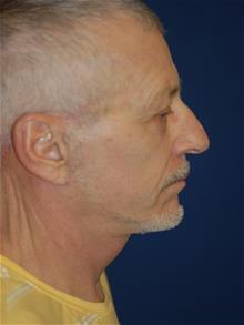 Facelift After Photo by Michael Eisemann, MD; Houston, TX - Case 28986