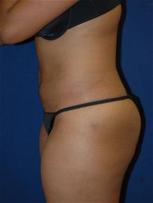 Liposuction After Photo by Michael Eisemann, MD; Houston, TX - Case 28992