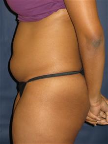 Liposuction Before Photo by Michael Eisemann, MD; Houston, TX - Case 28992