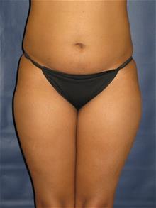 Liposuction Before Photo by Michael Eisemann, MD; Houston, TX - Case 28992