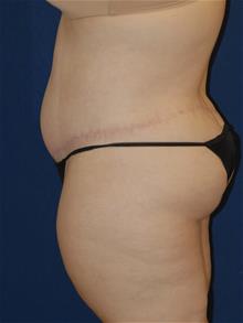 Tummy Tuck After Photo by Michael Eisemann, MD; Houston, TX - Case 28997