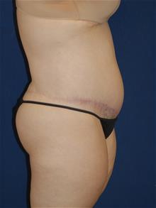 Tummy Tuck After Photo by Michael Eisemann, MD; Houston, TX - Case 28997