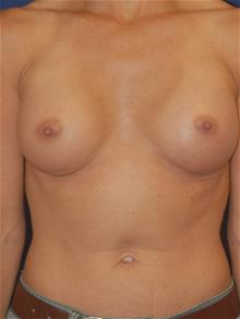 Breast Augmentation After Photo by Michael Eisemann, MD; Houston, TX - Case 28998