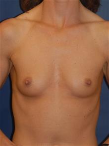 Breast Augmentation Before Photo by Michael Eisemann, MD; Houston, TX - Case 28998