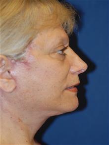 Facelift After Photo by Michael Eisemann, MD; Houston, TX - Case 29128