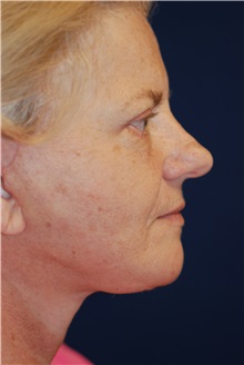 Facelift After Photo by Michael Eisemann, MD; Houston, TX - Case 29133