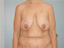 Body Contouring Before Photo by Richard Wassermann, MD, MPH, FACS; Columbia, SC - Case 21830