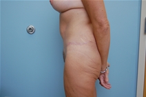 Body Contouring After Photo by Richard Wassermann, MD, MPH, FACS; Columbia, SC - Case 21830