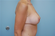 Body Contouring After Photo by Richard Wassermann, MD, MPH, FACS; Columbia, SC - Case 21830