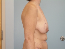 Body Contouring Before Photo by Richard Wassermann, MD, MPH, FACS; Columbia, SC - Case 21830