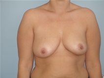Breast Reconstruction Before Photo by Richard Wassermann, MD, MPH, FACS; Columbia, SC - Case 21844