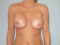 Breast Reconstruction After Photo by Richard Wassermann, MD, MPH, FACS; Columbia, SC - Case 21845