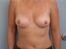 Breast Reconstruction Before Photo by Richard Wassermann, MD, MPH, FACS; Columbia, SC - Case 21845