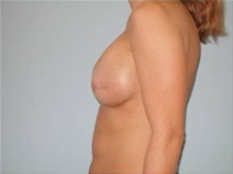 Breast Reconstruction After Photo by Richard Wassermann, MD, MPH, FACS; Columbia, SC - Case 21845