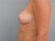 Breast Reconstruction Before Photo by Richard Wassermann, MD, MPH, FACS; Columbia, SC - Case 21845