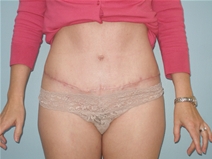 Tummy Tuck After Photo by Richard Wassermann, MD, MPH, FACS; Columbia, SC - Case 21850