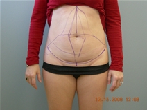 Tummy Tuck Before Photo by Richard Wassermann, MD, MPH, FACS; Columbia, SC - Case 21850