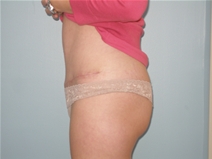 Tummy Tuck After Photo by Richard Wassermann, MD, MPH, FACS; Columbia, SC - Case 21850