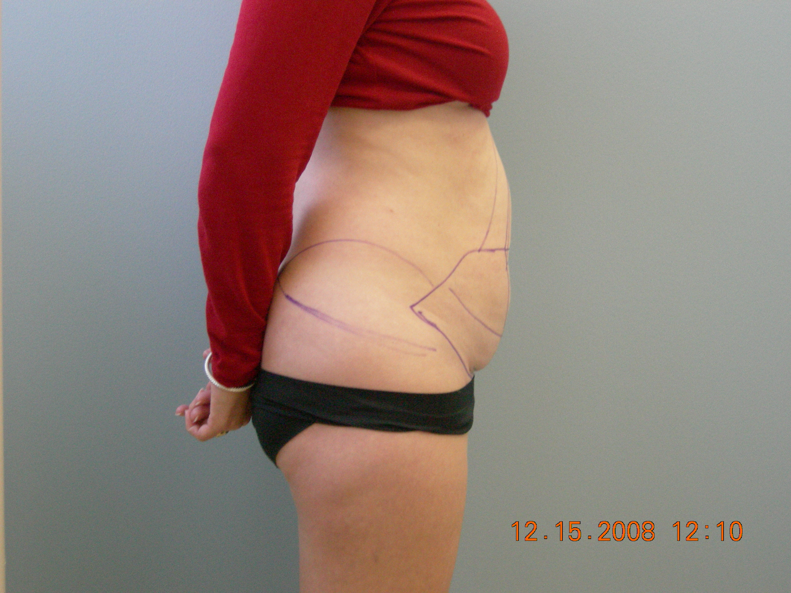 Tummy Tuck Columbia, SC