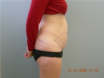 Tummy Tuck Before Photo by Richard Wassermann, MD, MPH, FACS; Columbia, SC - Case 21850