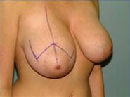 Breast Reduction Before Photo by Richard Wassermann, MD, MPH, FACS; Columbia, SC - Case 21916