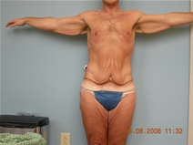 Body Contouring Before Photo by Richard Wassermann, MD, MPH, FACS; Columbia, SC - Case 21933
