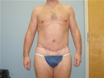 Body Contouring After Photo by Richard Wassermann, MD, MPH, FACS; Columbia, SC - Case 21933