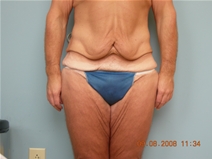 Body Contouring Before Photo by Richard Wassermann, MD, MPH, FACS; Columbia, SC - Case 21933