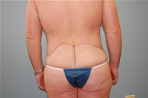 Body Contouring After Photo by Richard Wassermann, MD, MPH, FACS; Columbia, SC - Case 21933