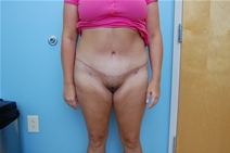 Tummy Tuck After Photo by Richard Wassermann, MD, MPH, FACS; Columbia, SC - Case 21944
