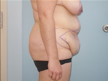 Tummy Tuck Before Photo by Richard Wassermann, MD, MPH, FACS; Columbia, SC - Case 21944