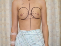 Breast Augmentation Before Photo by Richard Wassermann, MD, MPH, FACS; Columbia, SC - Case 21947
