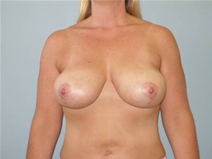 Breast Lift After Photo by Richard Wassermann, MD, MPH, FACS; Columbia, SC - Case 21953