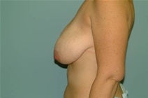 Breast Lift Before Photo by Richard Wassermann, MD, MPH, FACS; Columbia, SC - Case 21953