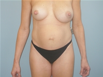Tummy Tuck Before Photo by Richard Wassermann, MD, MPH, FACS; Columbia, SC - Case 21991