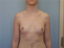 Breast Augmentation Before Photo by Richard Wassermann, MD, MPH, FACS; Columbia, SC - Case 22029