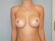Breast Augmentation After Photo by Richard Wassermann, MD, MPH, FACS; Columbia, SC - Case 22032