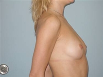 Breast Augmentation Before Photo by Richard Wassermann, MD, MPH, FACS; Columbia, SC - Case 22032