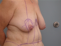 Breast Lift Before Photo by Richard Wassermann, MD, MPH, FACS; Columbia, SC - Case 22033
