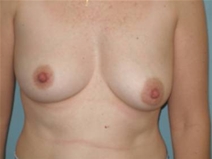 Breast Reconstruction Before Photo by Richard Wassermann, MD, MPH, FACS; Columbia, SC - Case 22034