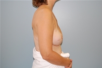 Breast Reconstruction After Photo by Richard Wassermann, MD, MPH, FACS; Columbia, SC - Case 22034
