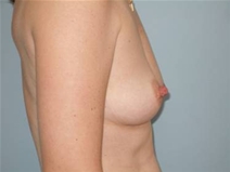 Breast Reconstruction Before Photo by Richard Wassermann, MD, MPH, FACS; Columbia, SC - Case 22034