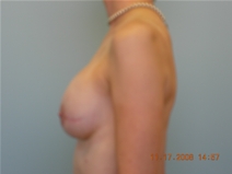 Breast Reconstruction After Photo by Richard Wassermann, MD, MPH, FACS; Columbia, SC - Case 22035