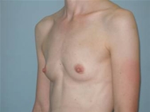 Breast Reconstruction Before Photo by Richard Wassermann, MD, MPH, FACS; Columbia, SC - Case 22035