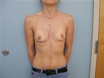 Breast Augmentation Before Photo by Richard Wassermann, MD, MPH, FACS; Columbia, SC - Case 22067