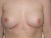 Breast Augmentation After Photo by Richard Wassermann, MD, MPH, FACS; Columbia, SC - Case 22069