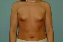 Breast Augmentation Before Photo by Richard Wassermann, MD, MPH, FACS; Columbia, SC - Case 22069